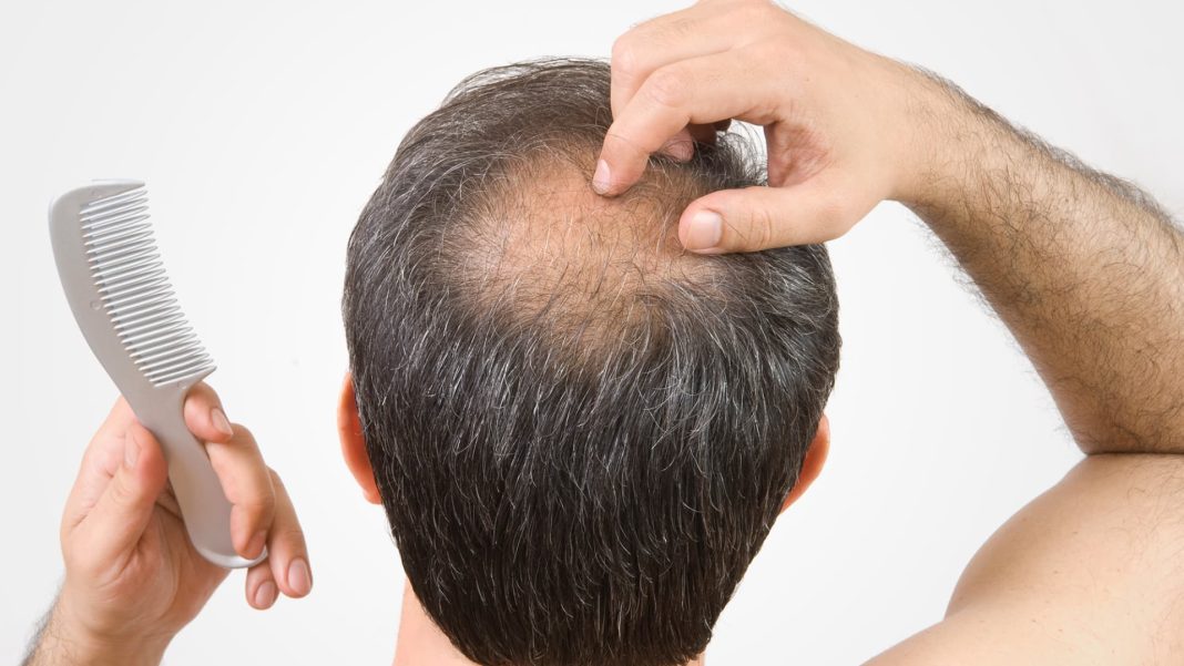 This biotech is leading what could be a 'GLP-1 moment for hair loss,' says BTIG